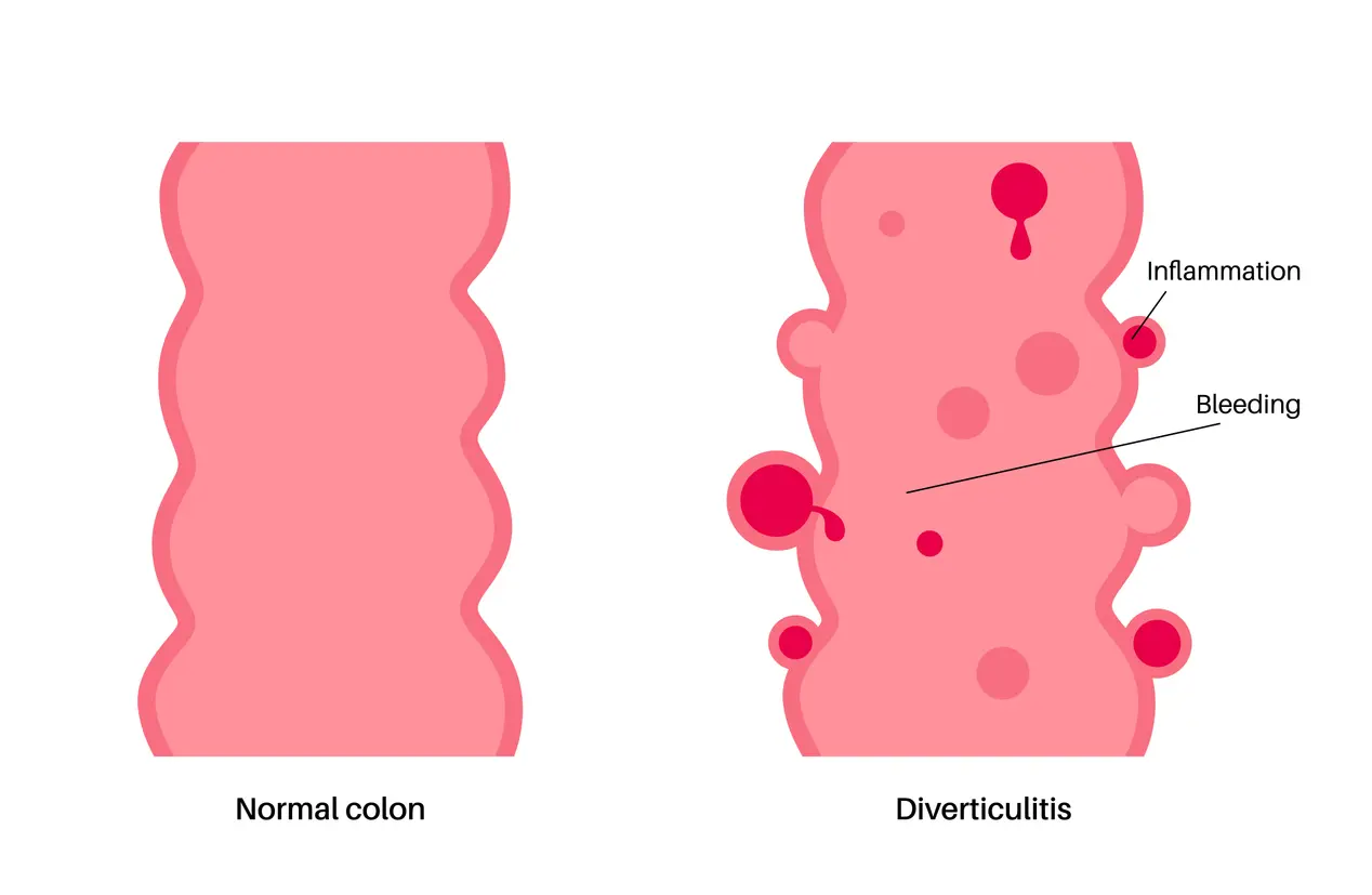 Everything to Know About the Diverticulitis Diet